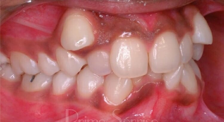 Featured image of post Sonhar Com Dente Encavalado Kit com 5 tangas c s largo micro fibra