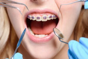 Aparelho ortodôntico