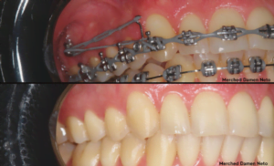 Mini Implantes
