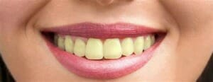 Dentes amarelados