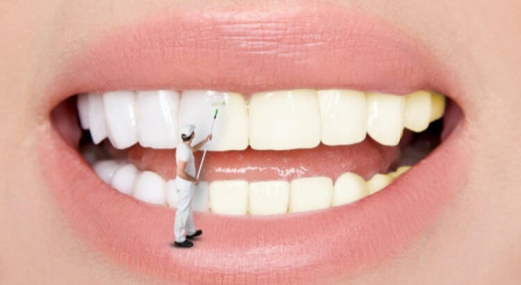 Clareamento Déntario