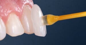 Facetas de Cerâmica