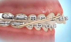 Elástico para corrigir dentes salientes