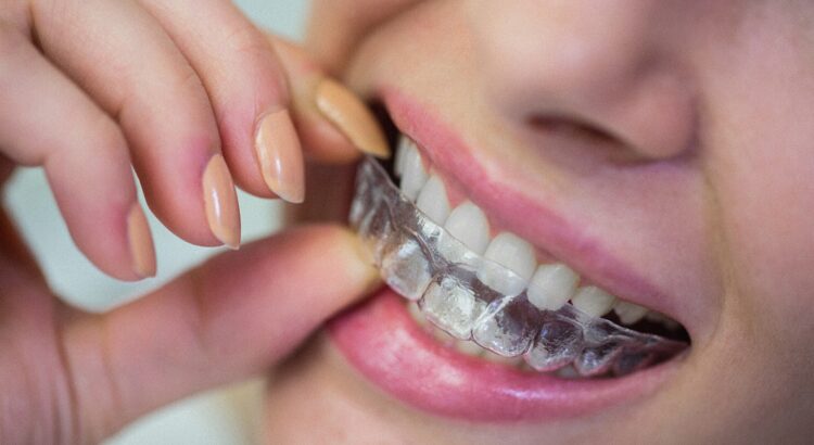 Prime Sorriso - Alinhadores Invisiveis - Invisalign