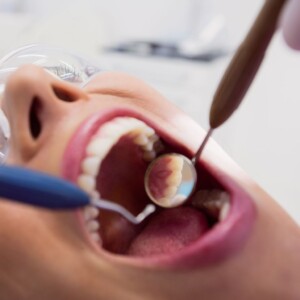 Como Funciona a Limpeza Dental Profissional