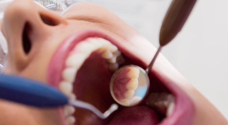 Como Funciona a Limpeza Dental Profissional