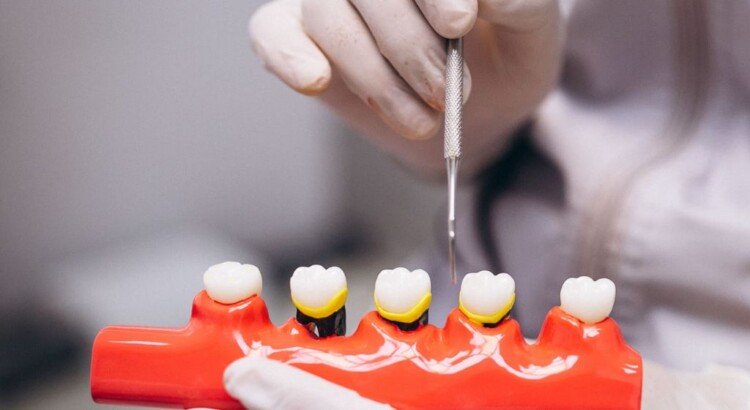 Como escolher entre implante dentário e ponte fixa