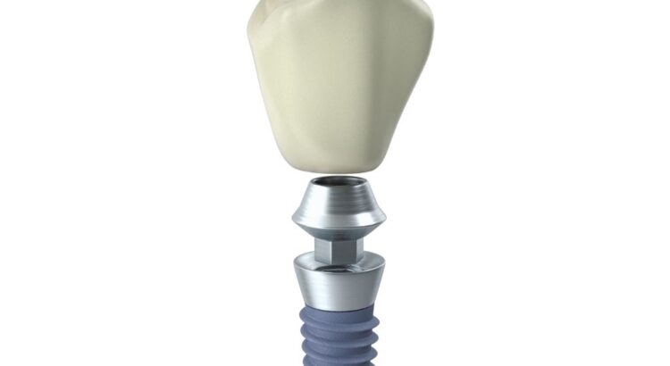 O que é o implante dentário