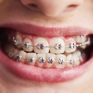 Aparelhos ortodônticos e desafios na fala