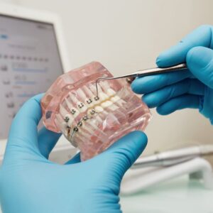 Aparelhos ortodônticos estéticos e suas vantagens