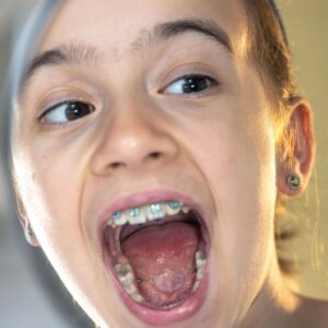 Importância da higiene bucal durante o tratamento ortodôntico