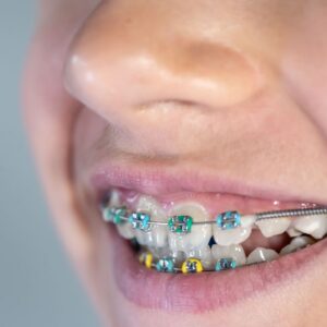 Uso contínuo do contensor após tratamento ortodôntico para manter dentes alinhados