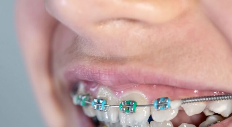 Uso contínuo do contensor após tratamento ortodôntico para manter dentes alinhados
