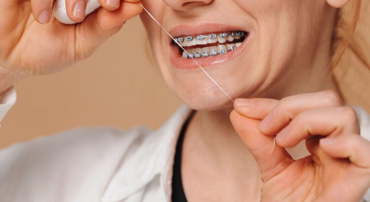 Higiene bucal eficaz durante o uso de aparelhos ortodônticos fixos