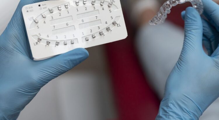 Retentores ortodônticos para manter os resultados do tratamento dentário