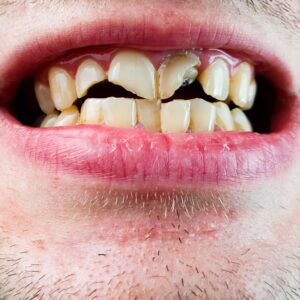 Tratamento ortodôntico para desgaste dentário causado por bruxismo e mordida desalinhada