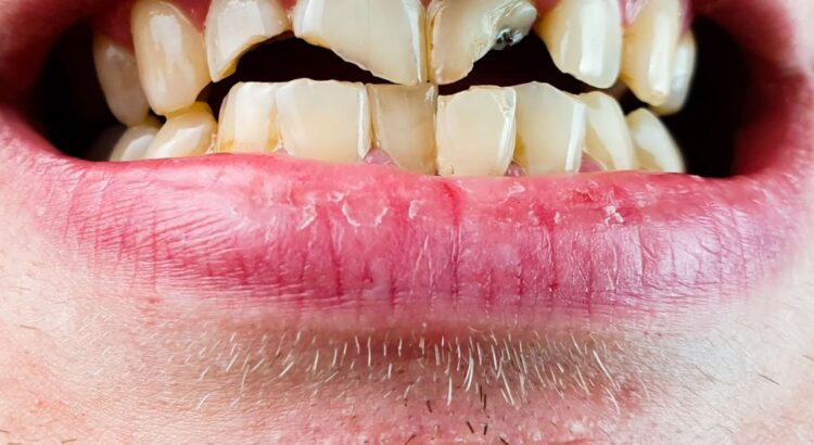 Tratamento ortodôntico para desgaste dentário causado por bruxismo e mordida desalinhada