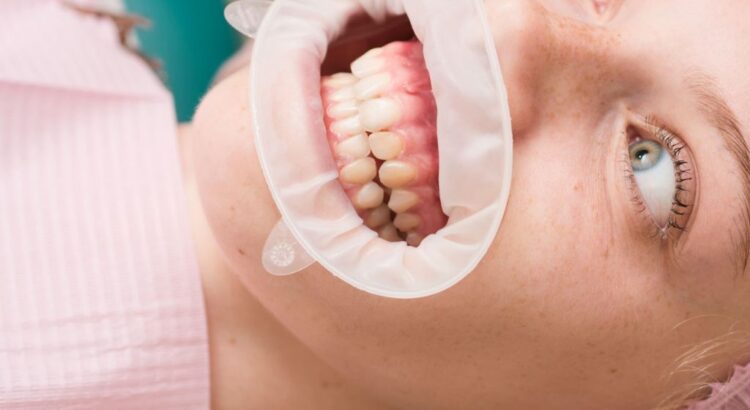 Tratamento ortodôntico para pacientes com fissura labiopalatina para melhorar estética e função