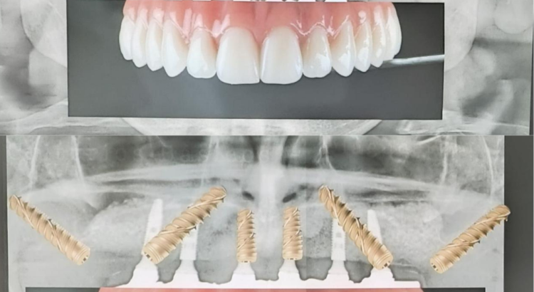 tipos de implantes dentários modernos com técnicas avançadas e tecnologia de ponta