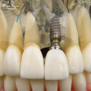 paciente tranquilo realizando cirurgia de implante dentário com anestesia local