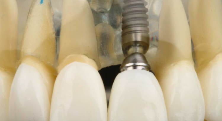 paciente tranquilo realizando cirurgia de implante dentário com anestesia local