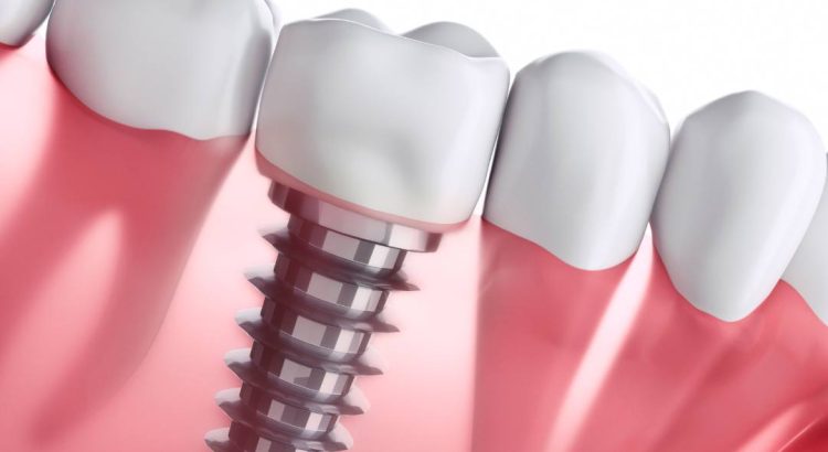 paciente em consulta odontológica para acompanhamento de implante dentário de longa duração