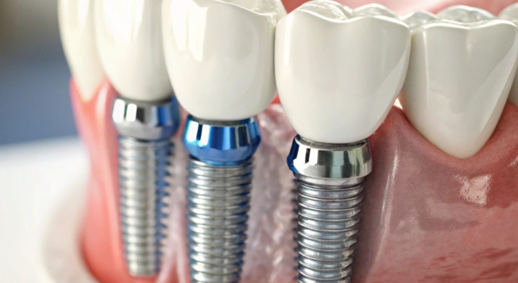 dentista avaliando implante dentário em paciente sorridente na Prime Sorriso