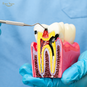 dentista explicando tratamento de canal ao paciente com modelo dental