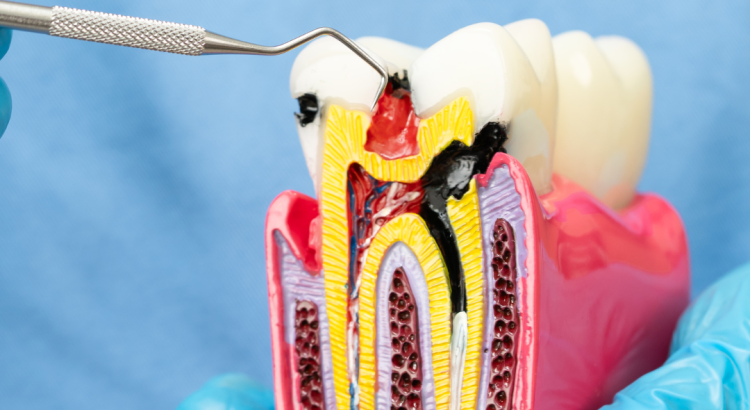 dentista explicando tratamento de canal ao paciente com modelo dental
