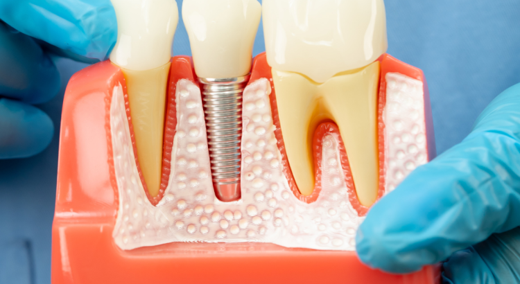 paciente em consulta sobre implante dentário na Prime Sorriso