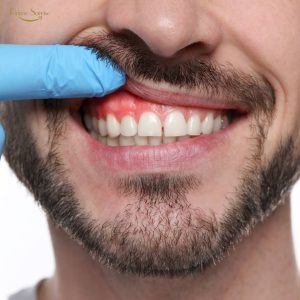 Escovação dos dentes e cuidado com a gengiva para prevenir sangramento e inflamação