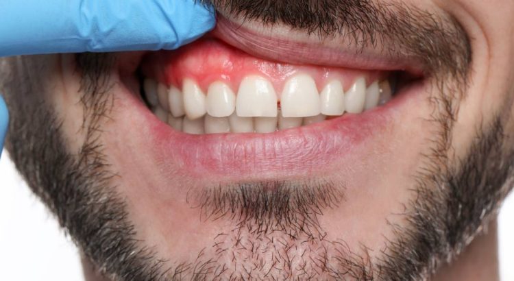 Escovação dos dentes e cuidado com a gengiva para prevenir sangramento e inflamação