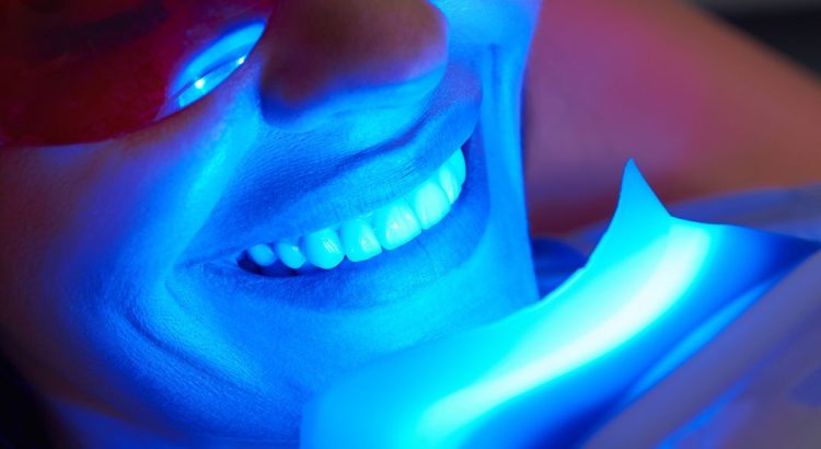 Sorriso branco após clareamento dental com orientação profissional