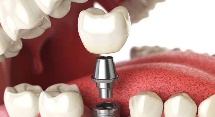 Close de dentes com acúmulo de tártaro antes de limpeza odontológica