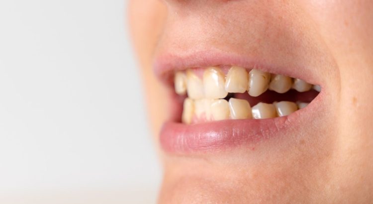 Pessoa dormindo com sinais de ranger de dentes associados ao bruxismo