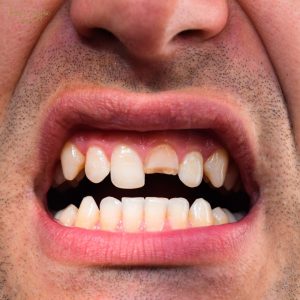 Dente quebrado sendo avaliado por dentista para definir tratamento adequado
