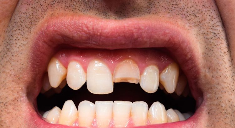 Dente quebrado sendo avaliado por dentista para definir tratamento adequado