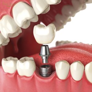 Close de dentes com acúmulo de tártaro antes de limpeza odontológica